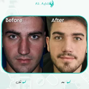 Before-After-8