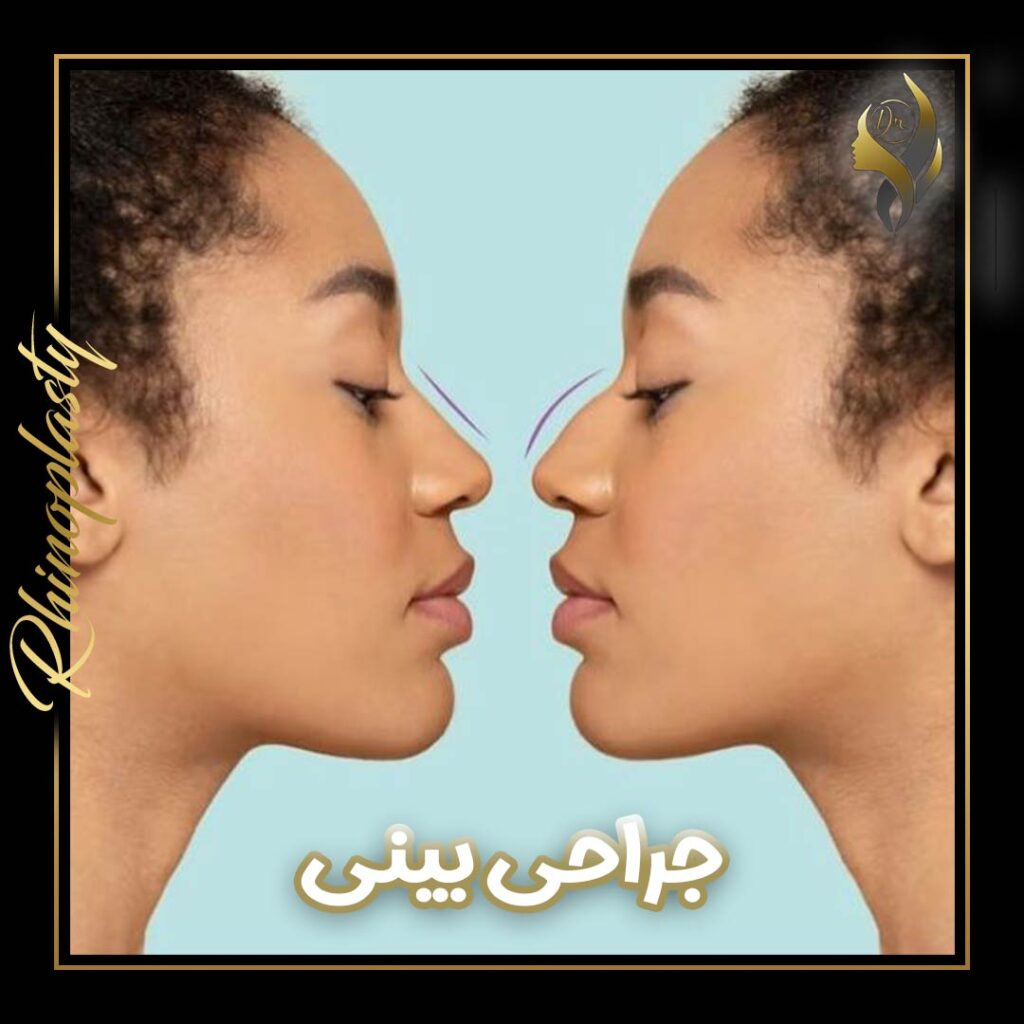 جراحی بینی- دکتر علی عقیلی