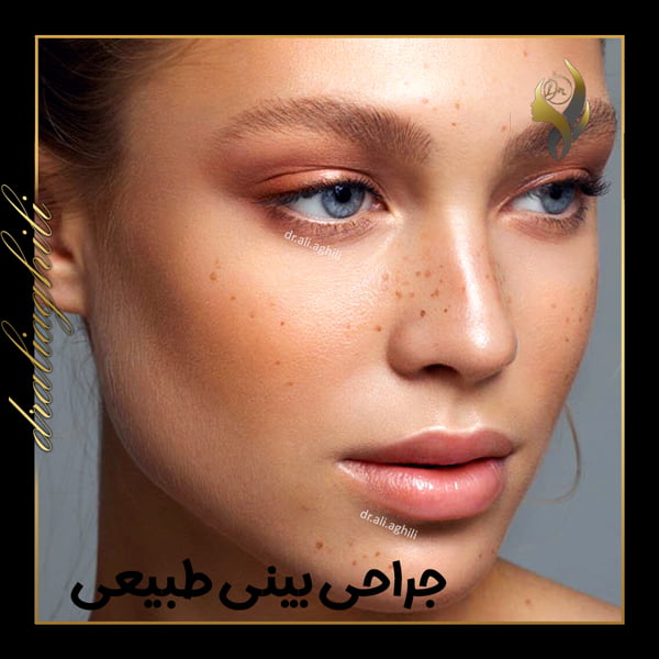 جراحی بینی طبیعی - دکتر علی عقیلی