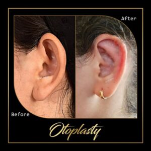 جراحی گوش جراحی گوش - دکتر علی عقیلی