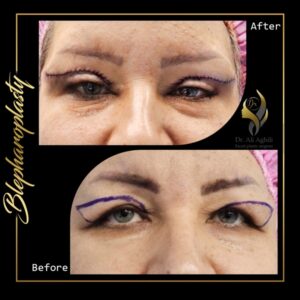 جراحی پلک و افزایش زیبایی ظاهری جراحی پلک - دکتر علی عقیلی