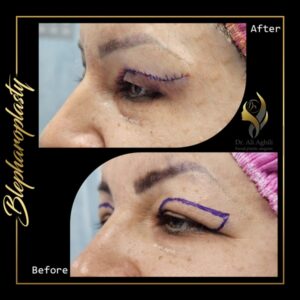 جراحی پلک و افزایش زیبایی ظاهری جراحی پلک - دکتر علی عقیلی