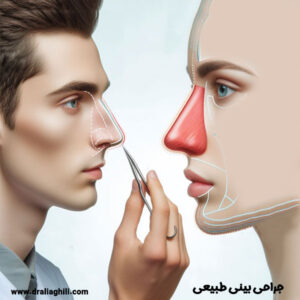 جراحی بینی طبیعی - دکتر علی عقیلی