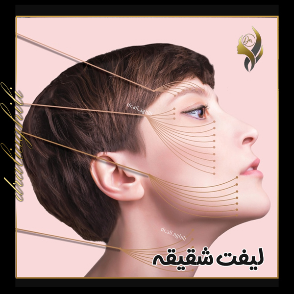 لیفت شقیقه - دکتر علی عقیلی