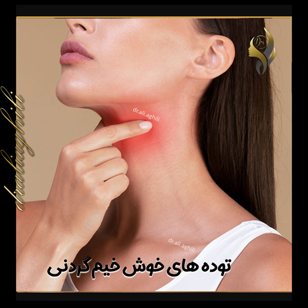 توده‌ های خوش‌ خیم گردنی - دکتر علی عقیلی