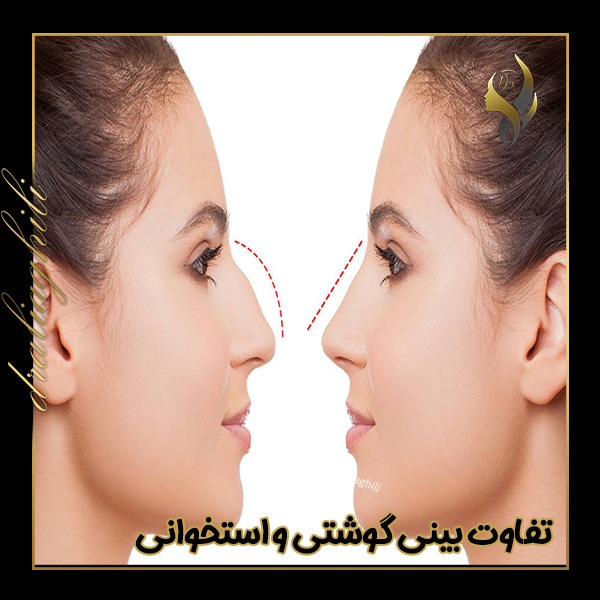 تفاوت بینی گوشتی و استخوانی - https://draliaghili.com/