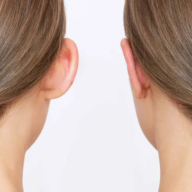 جراحی زیبایی گوش (اتوپلاستی)