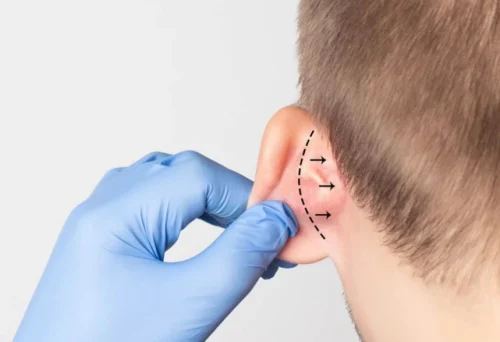 جراحی زیبایی گوش