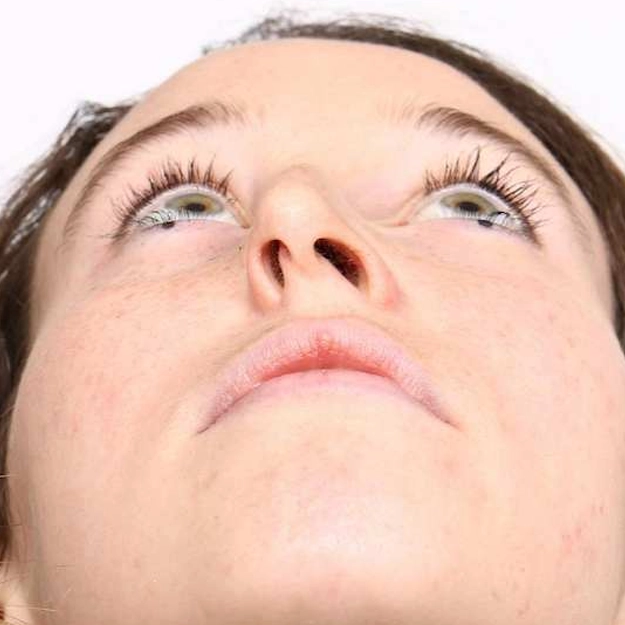 جراحی انحراف بینی (سپتوپلاستی)