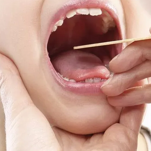 جراحی لوزه (تونسیلکتومی)