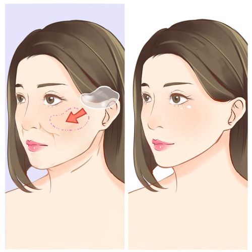 لیفت گونه با پروتز