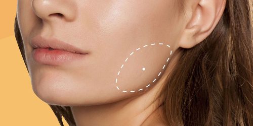 برداشتن چربی (بوکال فت) برداشتن چربی (بوکال فت)