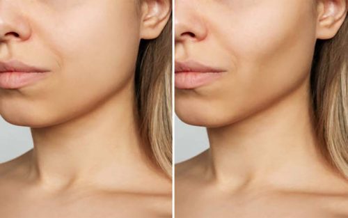 برداشتن چربی (بوکال فت) برداشتن چربی (بوکال فت)