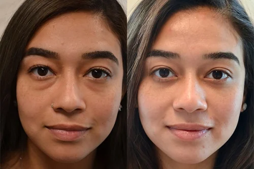 تزریق چربی به صورت