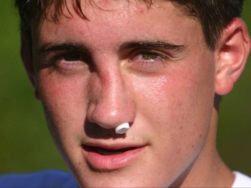 جااندازی شکستگی بینی