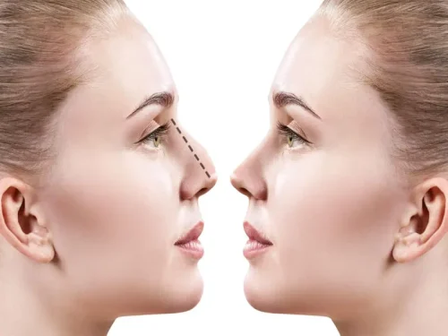 جراحی انحراف بینی (سپتوپلاستی) جراحی انحراف بینی