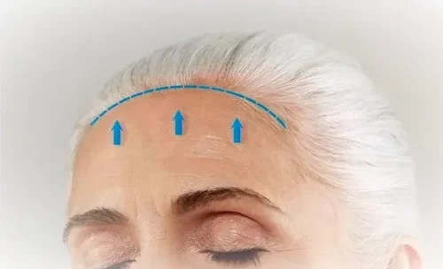 لیفت پیشانی