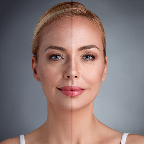 لیفت گونه لیفت گونه