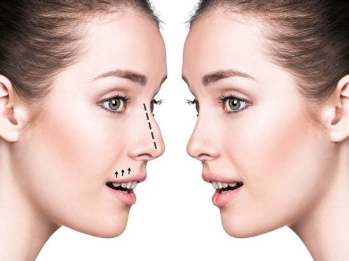 جراحی انحراف بینی (سپتوپلاستی) جراحی انحراف بینی(سپتوپلاستی)