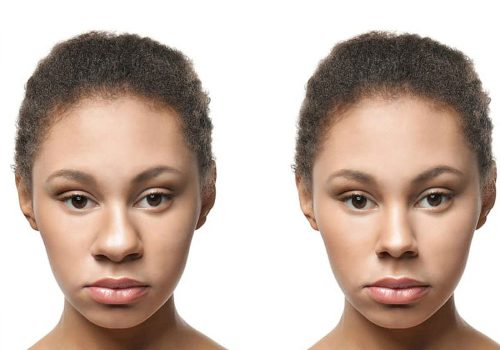 جراحی بینی گوشتی - ویژگی‎های بارز بینی گوشتی - نحوه جراحی بینی گوشتی