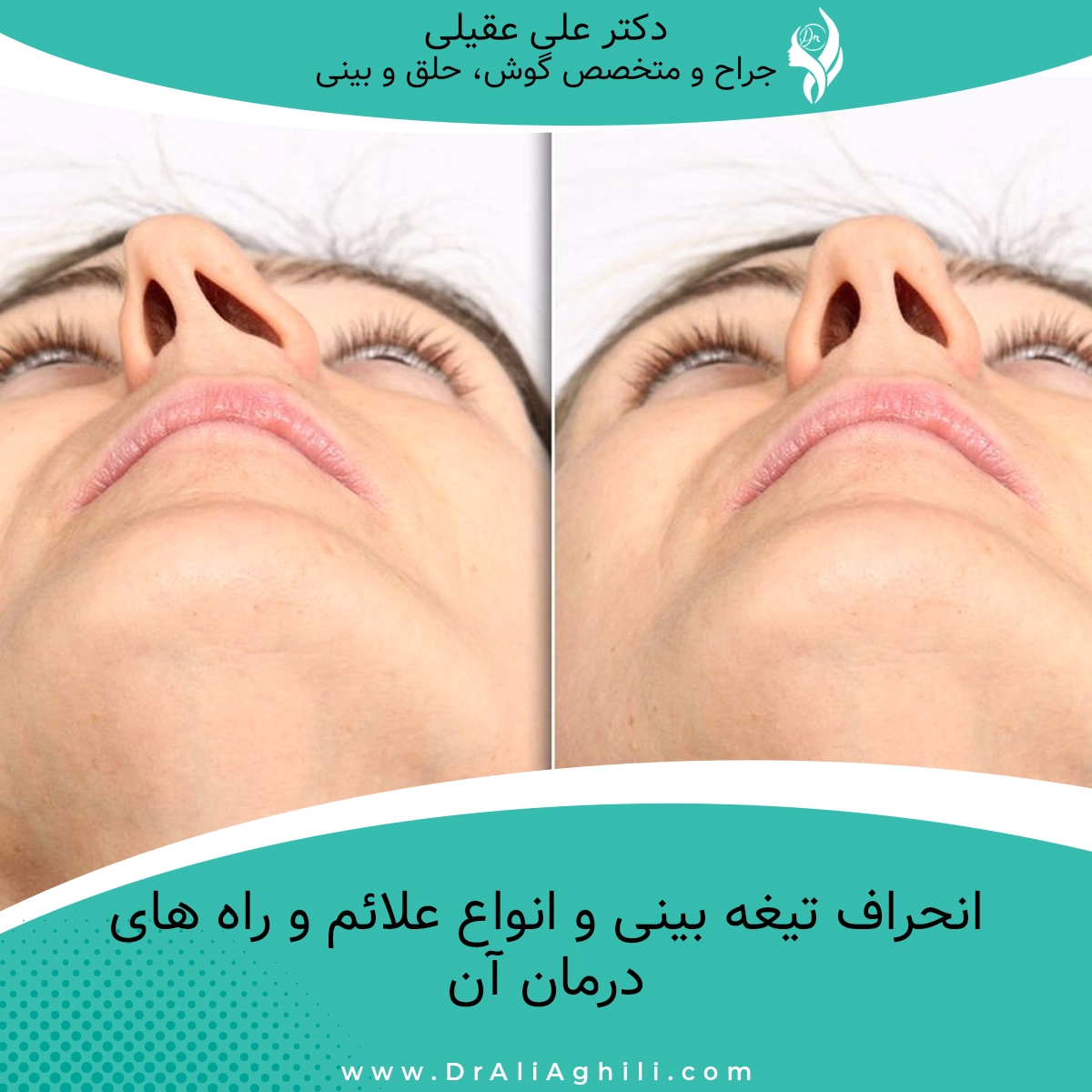 انحراف تیغه بینی و انواع علائم و راه های درمان آن