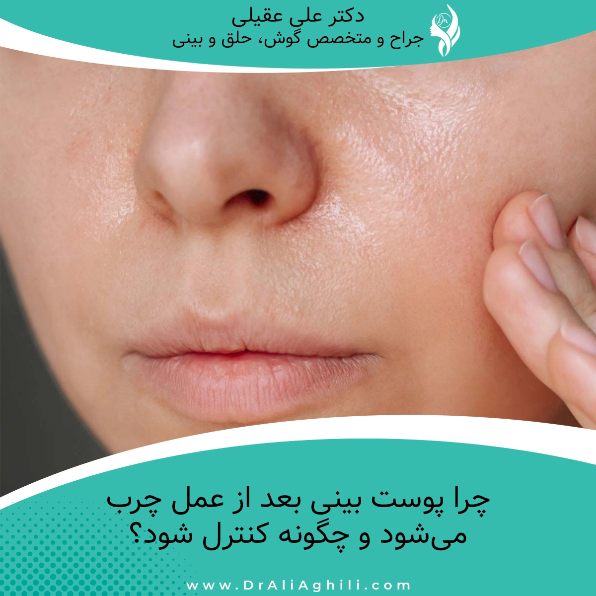 چرا پوست بینی بعد از عمل چرب می‌شود و چگونه کنترل شود؟