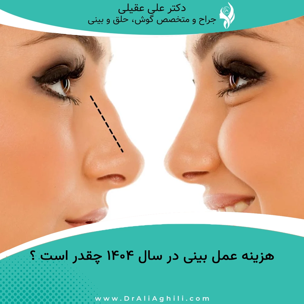 هزینه عمل بینی در سال ۱۴۰۴ چقدر است ؟