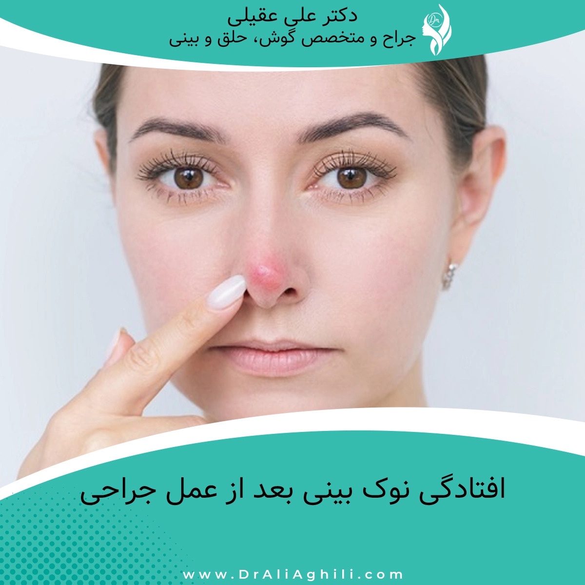 افتادگی نوک بینی بعد از عمل جراحی