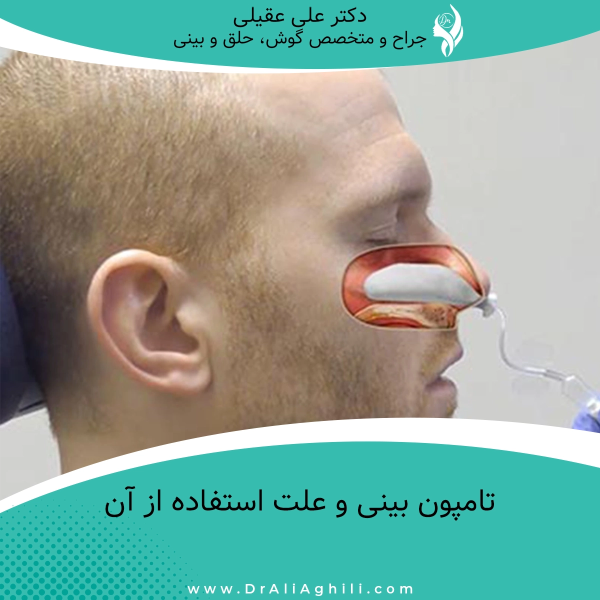 تامپون بینی و علت استفاده از آن