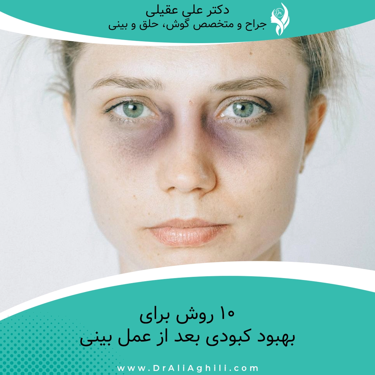 10 روش برای بهبود کبودی بعد از عمل بینی