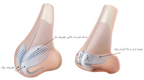 اصلاح افتادگی بینی