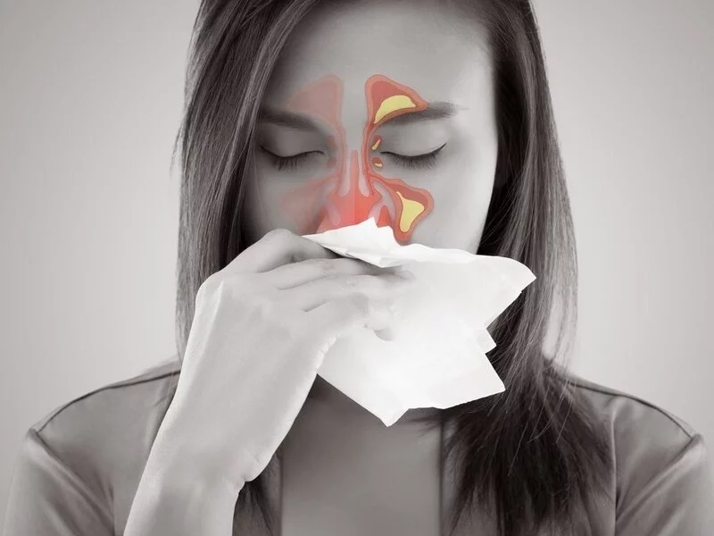 رابطه سینوزیت و جراحی بینی
