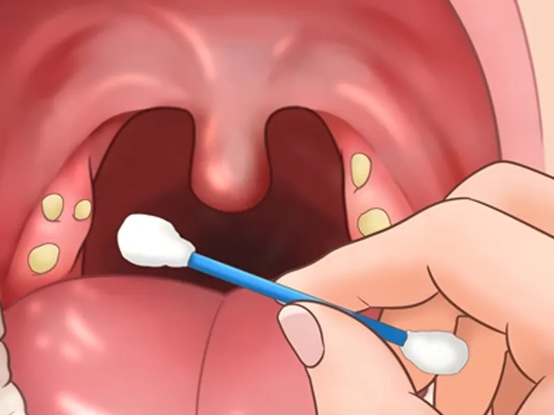 جراحی لوزه: آنچه از عمل تا بهبودی باید بدانید جراحی لوزه | لوزه سوم | جراحی لوزه سوم | درمان لوزه سوم | بهترین جراح لوزه