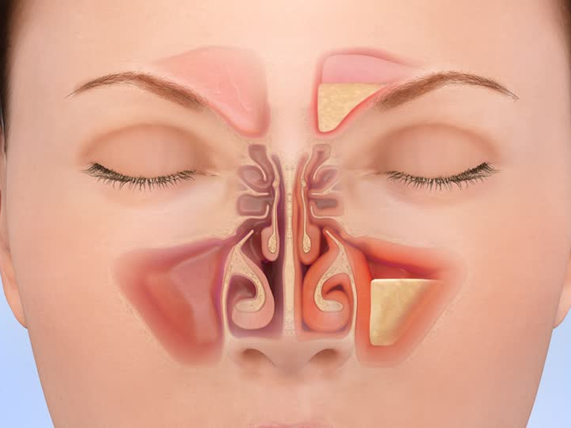 رابطه سینوزیت و جراحی بینی رابطه سینوزیت و جراحی بینی