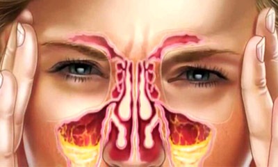 رابطه سینوزیت و جراحی بینی تاثیر سینوزیت بر روی جراحی بینی؛ عمل سینوزیت و زیبایی بینی | رابطه سینوزیت و جراحی بینی