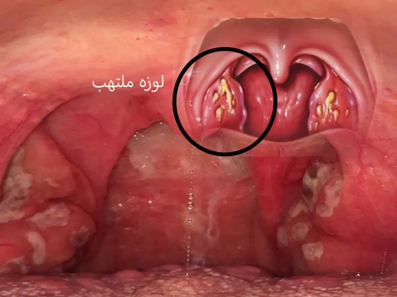 جراحی لوزه: آنچه از عمل تا بهبودی باید بدانید جراحی لوزه | لوزه سوم | جراحی لوزه سوم | درمان لوزه سوم | بهترین جراح لوزه