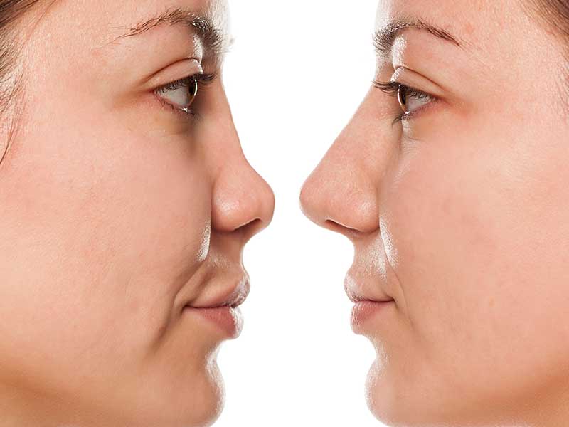 جراحی بینی گوشتی: آیا بینی گوشتی برمیگرده ؟