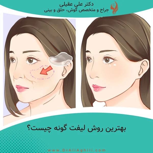 بهترین روش لیفت گونه چیست؟