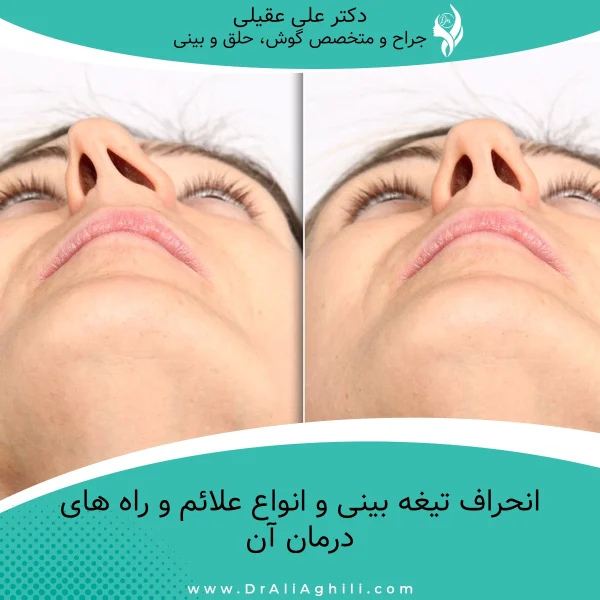 انحراف تیغه بینی و انواع علائم و راه های درمان آن