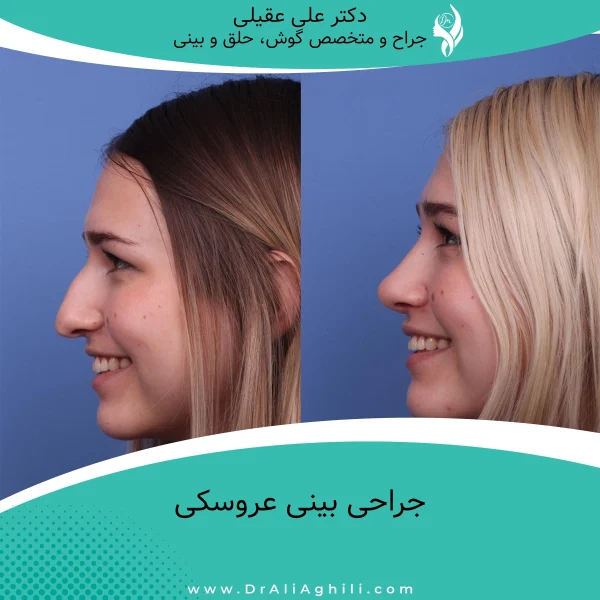 جراحی بینی عروسکی
