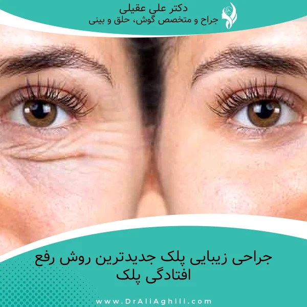 جراحی زیبایی پلک جدیدترین روش رفع افتادگی پلک