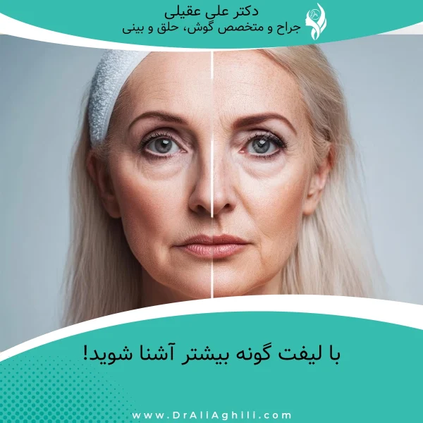 با لیفت گونه بیشتر آشنا شوید!