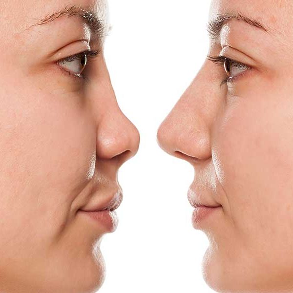 جراحی بینی گوشتی: آیا بینی گوشتی برمیگرده ؟