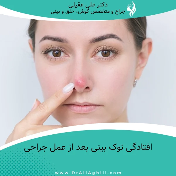 افتادگی نوک بینی بعد از عمل جراحی