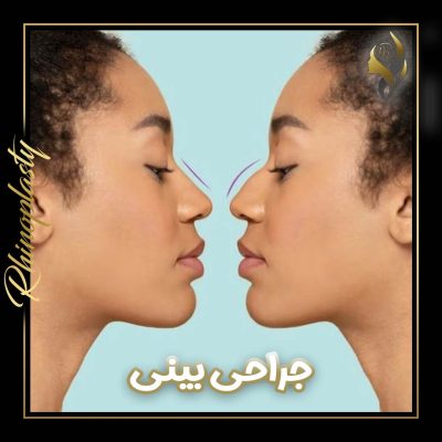 جراحی بینی- دکتر علی عقیلی